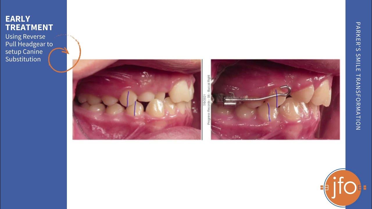 Early Treatment with Reverse Pull Headgear and Canine Substitution Joosse Family Orthodontics