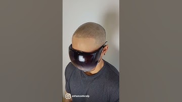 botched hair tattoo repair 2nd session of Scalp Micropigmentation #scalpmicropigmentation #smp