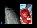 PROXIMAL HUMERUS FRACTURES  SURGICAL  APPROACHES - TIPS, TRICKS AND PITFALLS