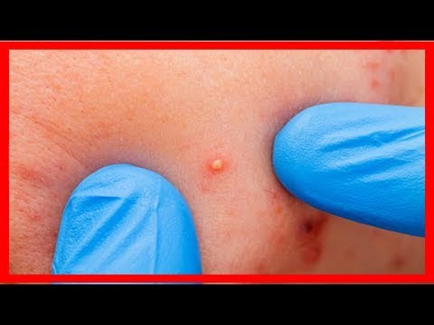 Cómo deshacerte del acné en la espalda