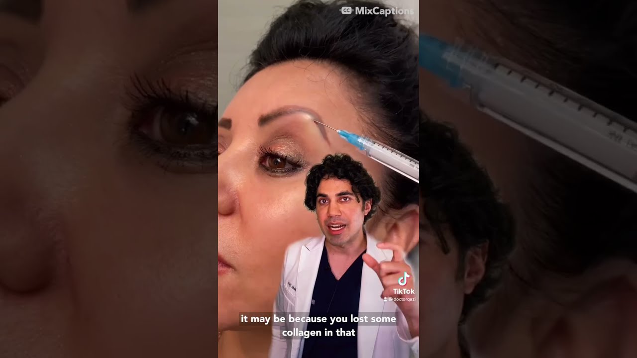 Подтяжка бровей филлерами от доктора Надира Кази