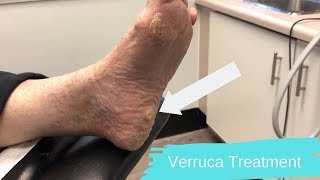 Verruca Pedis | Wart Treatment