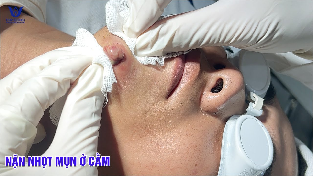 Điều trị mụn áp ở cằm sưng viêm nhiều dịch mủ - Tại phòng khám da liễu HHV Clinic.