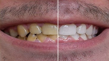 HOW TO GET RID OF YELLOW TEETH STEP BY STEP GUIDE