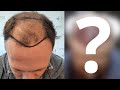 HAIR TRANSPLANT in turkey! (whole journey)