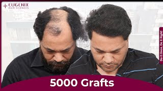 Hair Transplant in Bengaluru: Best Results & Cost of Hair Transplant in Bengaluru