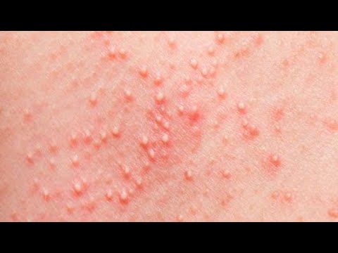 علاج الطفح الجلدي عند الأطفال