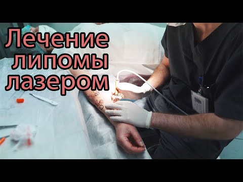 Удаление липомы лазером