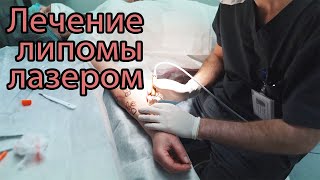 Удаление липомы лазером