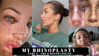 MY RHINOPLASTY PART 3 - The 6 month update, recovery photos + Q&A | Asher Mary-Lou