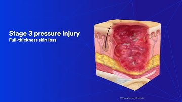 Pressure Injury Education: Chapter 3 Staging