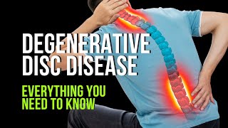 Degenerative Disc Disease  Everything You Need to Know