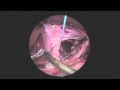 Laparoscopic Nissen Fundoplication - Narrated - 3mm JustRight Sealer