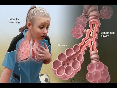 Top 6 Natural Remedies for Asthma | Wheezing Treatment