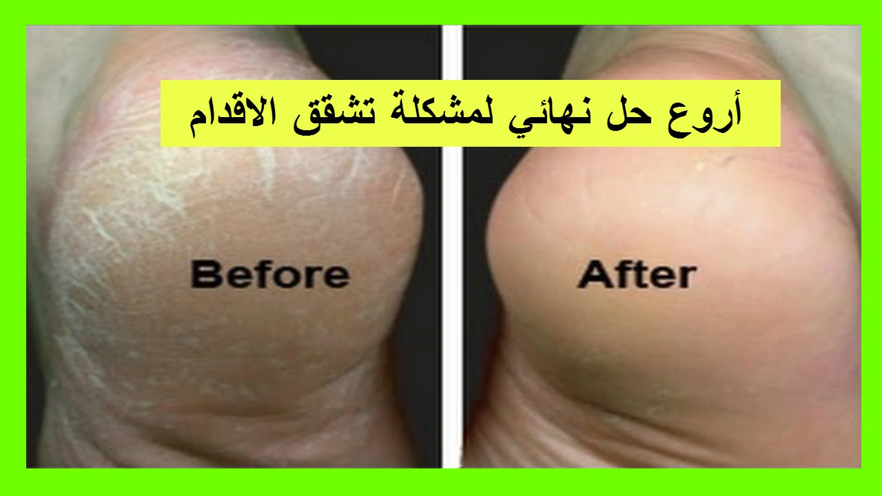 حل نهائي لمشكلة تشقق الاقدام في يوم واحد