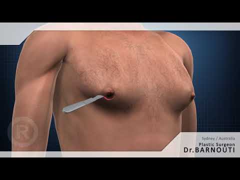 Videó: Gynecomastia - Okai, Tünetei, Diagnózisa, Kezelése