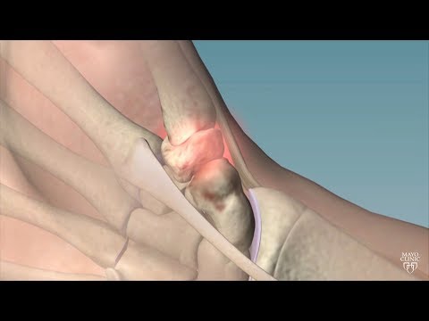 Mayo Clinic Minute: Cause, remedies for thumb arthritis