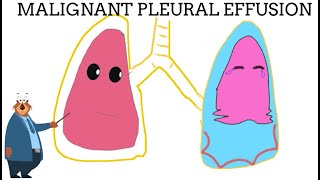 Pleural effusion from cancer explained in 5 minutes