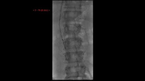 IVC filter retrieval