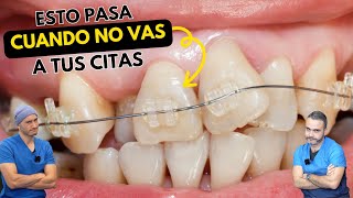 Nunca dejes de ir a tus citas dentales 😱 by Dr. Federico Baena Q 11,079 views 4 months ago 12 minutes, 5 seconds
