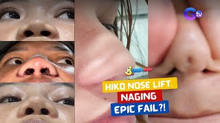 Download lagu Hiko nose lift, naging epic fail?! | I Juander