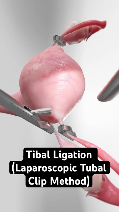 Clipping fallopian tubes to prevent pregnancy (3D Animation)