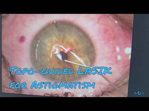 Lasik for astigmatism deals