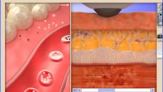 Class IV Laser Animations screenshot 2