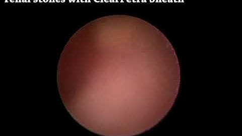 PCNL pneumatic lithotripsy for renal stones with ClearPetra Sheath