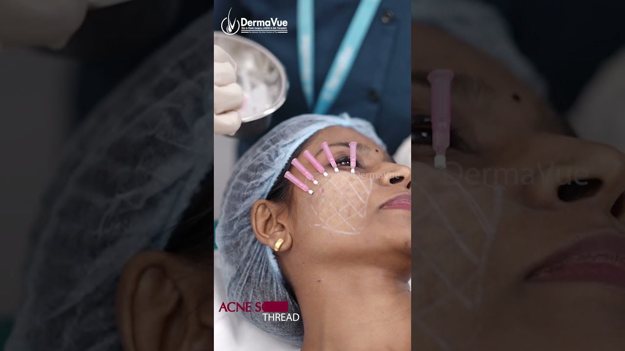 ✨"Thread Lifting for Acne Scars: A Renewed Complexion"✨🧬🩺 
