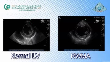 051 Regional LV Function RWMA TEE KAMC