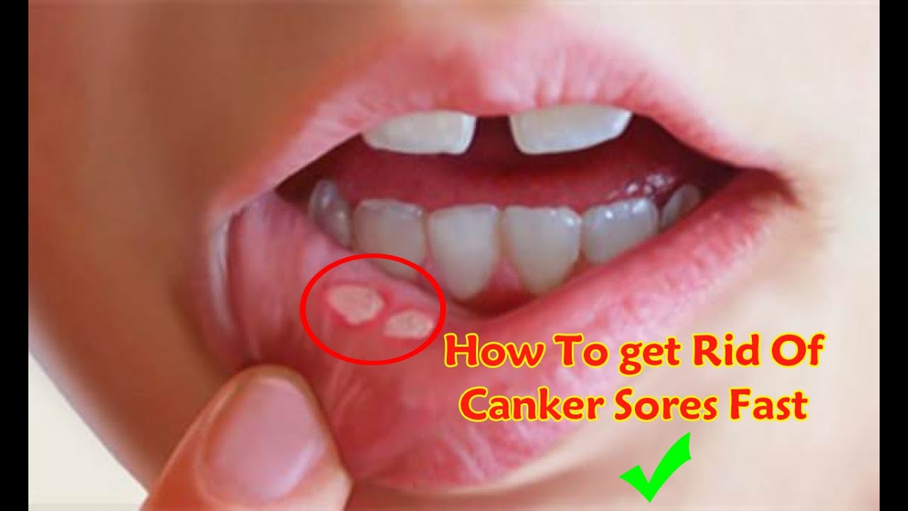 How To Get Rid Of Canker Sores Fast and Permanently (party