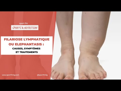 Vidéo: Comment reconnaître et prévenir la filariose lymphatique : 12 étapes