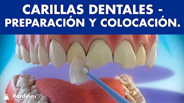 ¿Cuántos dientes cubren las carillas?