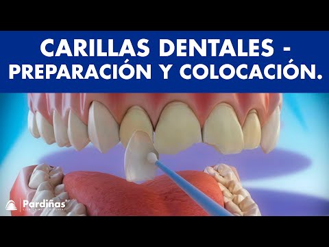 Carillas Dentales • Dental Company