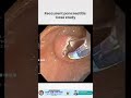 Recurrent Pancreatitis Case Study | Expert Gastro Care at Viraj Gastro & Liver Centre