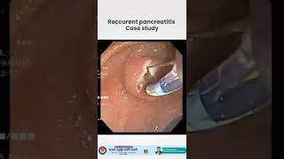 Recurrent Pancreatitis Case Study | Expert Gastro Care at Viraj Gastro & Liver Centre