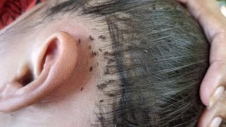 Getting out all of thousand lice from black hair - Remove all of lice from long hair