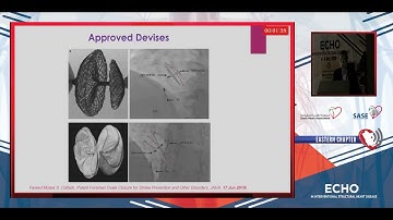 Paten Foramen Ovale (PFO) and Cryptogenic Stroke