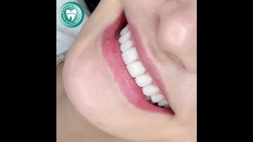 CHỈ CẦN BỌC SỨ CÓ NGAY NỤ CƯỜI HOÀN HẢO