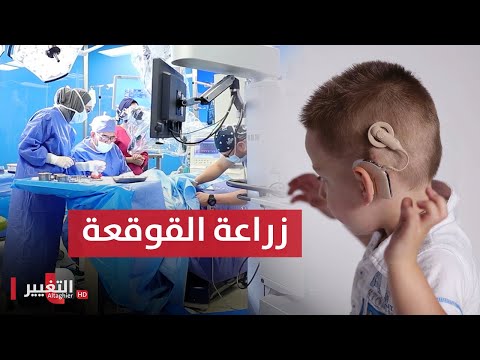شاهد عملية زراعة قوقعة الأذن مع الدكتور محمد الطوالبة