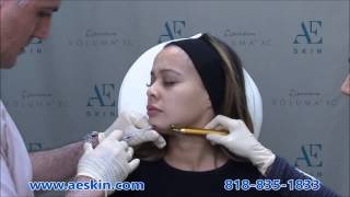 Voluma Demonstration 5 Chin Augmentation - A E Skin - Encino, CA - 818-835-1833