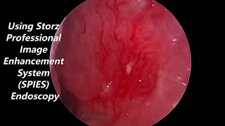 Nasal Septum Little's Area Vascular Ectasia Causing Nose Bleed (Epistaxis)