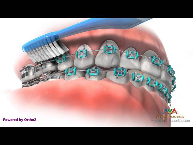 Life with Braces - Brushing & Flossing class=