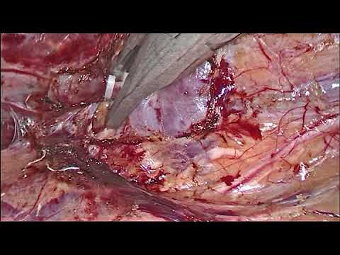 Video: Binyrekreft (Pheochromocytoma) Hos Katter