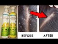 रूसी खत्म, बाल होंगे मुलायम और मजबूतMamaearth Lemon anti dandruff shampoo and conditioner review #sg