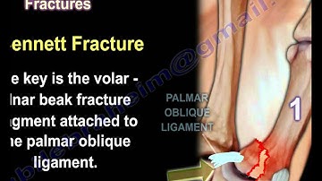 Thumb Metacarpal Base Fracture Injury - Everything You Need To Know - Dr. Nabil Ebraheim