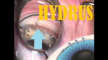 How to: HYDRUS MIGS shunt from Ivantis