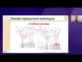 4. Minimally Invasive Mitral Valve Repair. Dr. Piroze Davierwala -