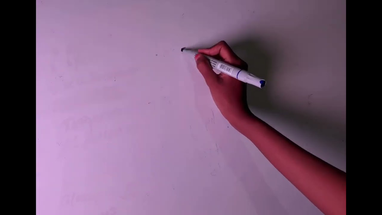 Siderosis bulbi and chalcosis (copper and iron IOFB)